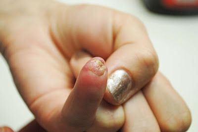 Tricia's finger 008