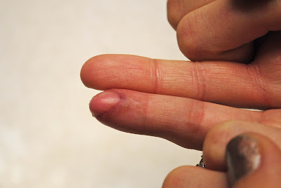 Tricia's finger 015